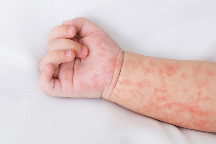 Skin Conditions Related to Allergies