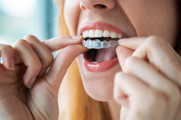 Why Should Working Professionals Go for Invisalign