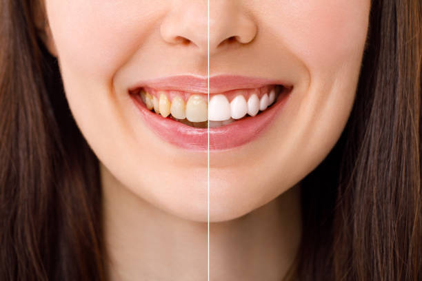 Brightening Smiles with Modern Teeth Whitening Solutions