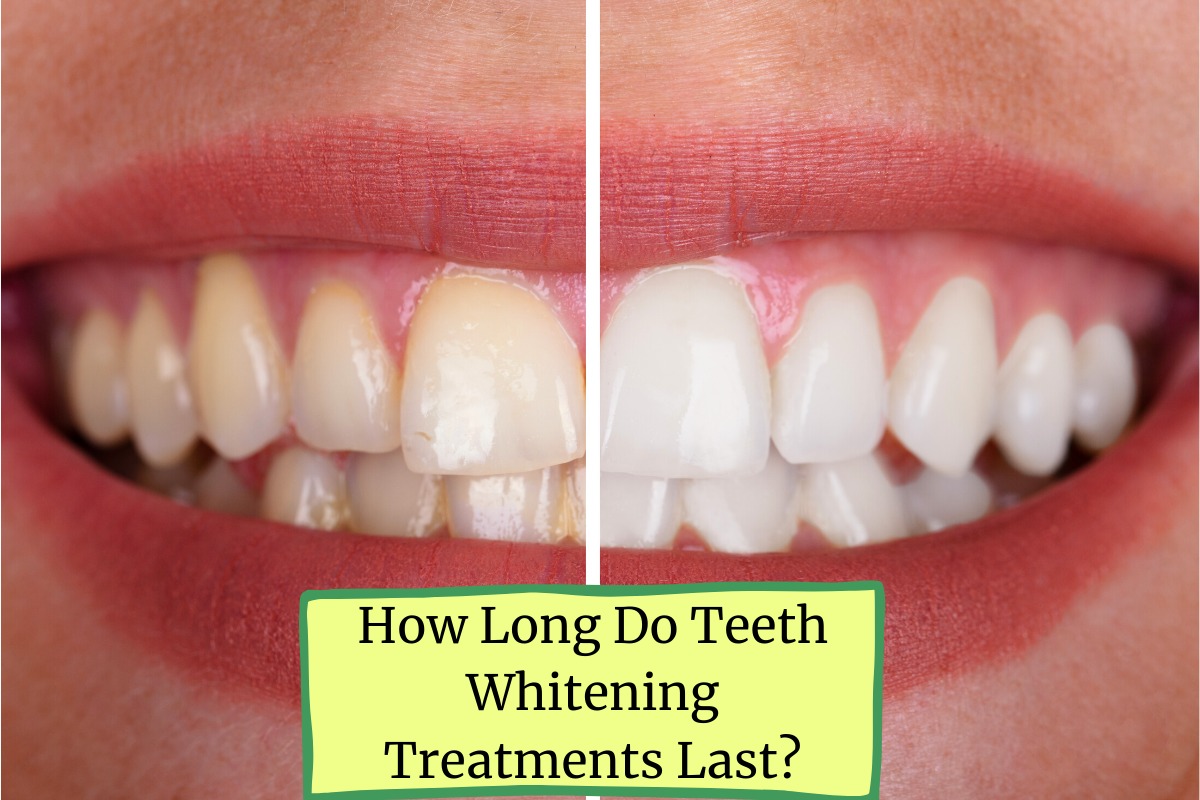 How Long Do Teeth Whitening Treatments Last?
