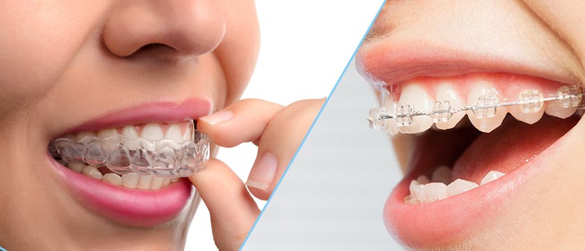 Clear Braces (Ceramic braces) Vs Invisalign: Things You Need To Know
