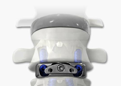Interbody Cage Market Expected to Expand at a Steady CAGR through 2025
