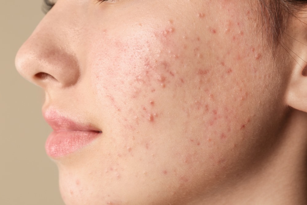 Herbal Medicine for Acne Vulgaris - Why Specialist Recommend Herbal Medicine For Acne Vulgaris Treatment?