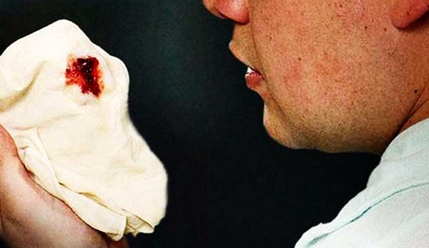 Nosebleed Treatment - Natural Remedies for Nose Bleeding