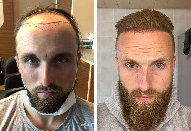 The Cost of Hair Transplants in the UK: A Complete Guide