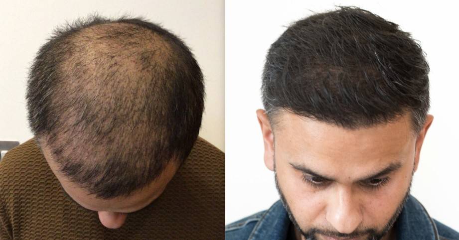 Unlocking the Secrets of Hair Transplants in the UK: A Comprehensive Guide