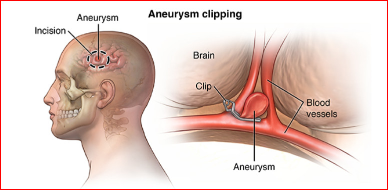Brain Aneurysm Clipping