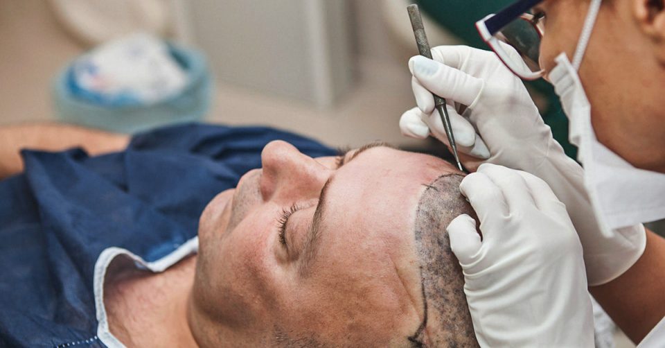 Explain The Combination Technique of FUT+ FUE+BHT