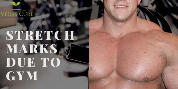 Stretch marks due to gym