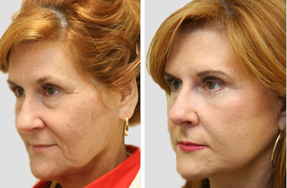 Facelift New York | Facelift New York Cost