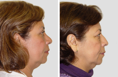 Blepharoplasty Eyelid NY | Blepharoplasty Eyelid NYC