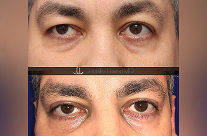 What is the cost for blepharoplasty?