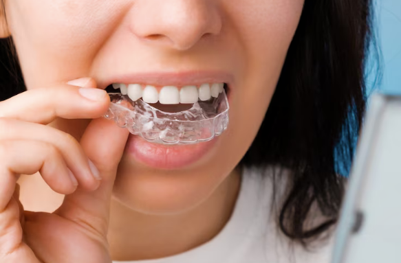 Unlock Your Best Smile with Fond du Lac Invisalign