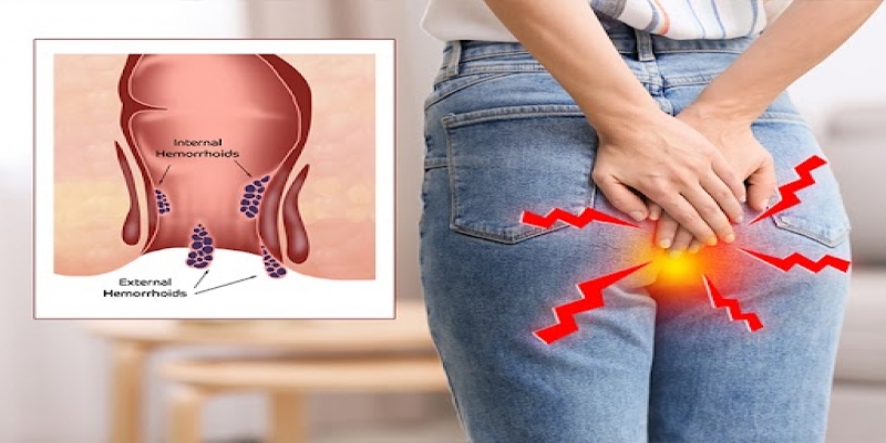 Best Laser Treatment for Piles: Benefits & Risks