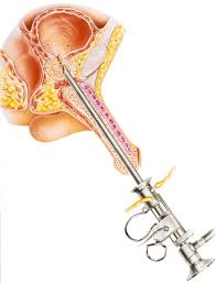 Prostatic Artery Embolization Market Size, Status, Growth | Industry Analysis Report 2020-2027