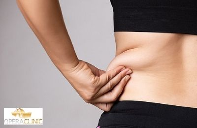 Best Fat Removal Treatment London | Opera Clinic