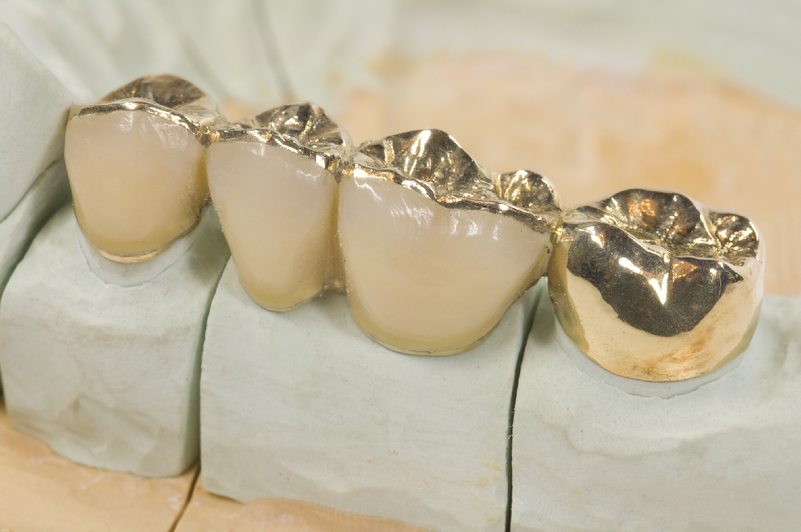 Dental Inlays and Onlays Market 2022 Major Key Players and Industry Analysis Till 2028