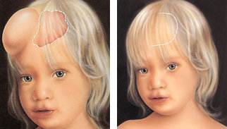 Tissue Expansion Marke Outlook, Growth, Analysis Report