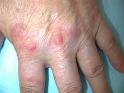 Utilize Natural Remedies to abolish Granuloma Annulare Skin Disease