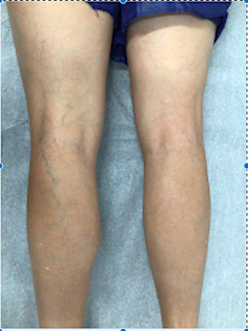 The Right Treatments For Spider Veins