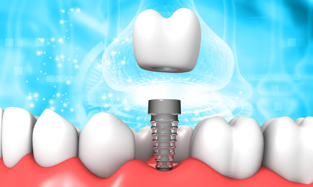 Top Habits for Maintaining Your Dental Implants