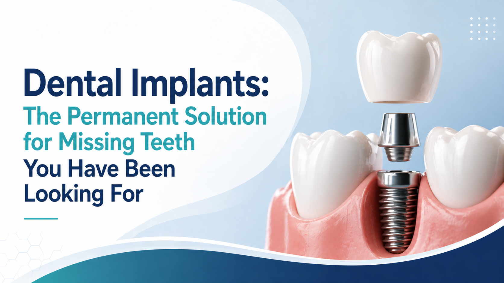Dental Implants: The Permanent Solution for Missing Teeth You Have Been Looking For