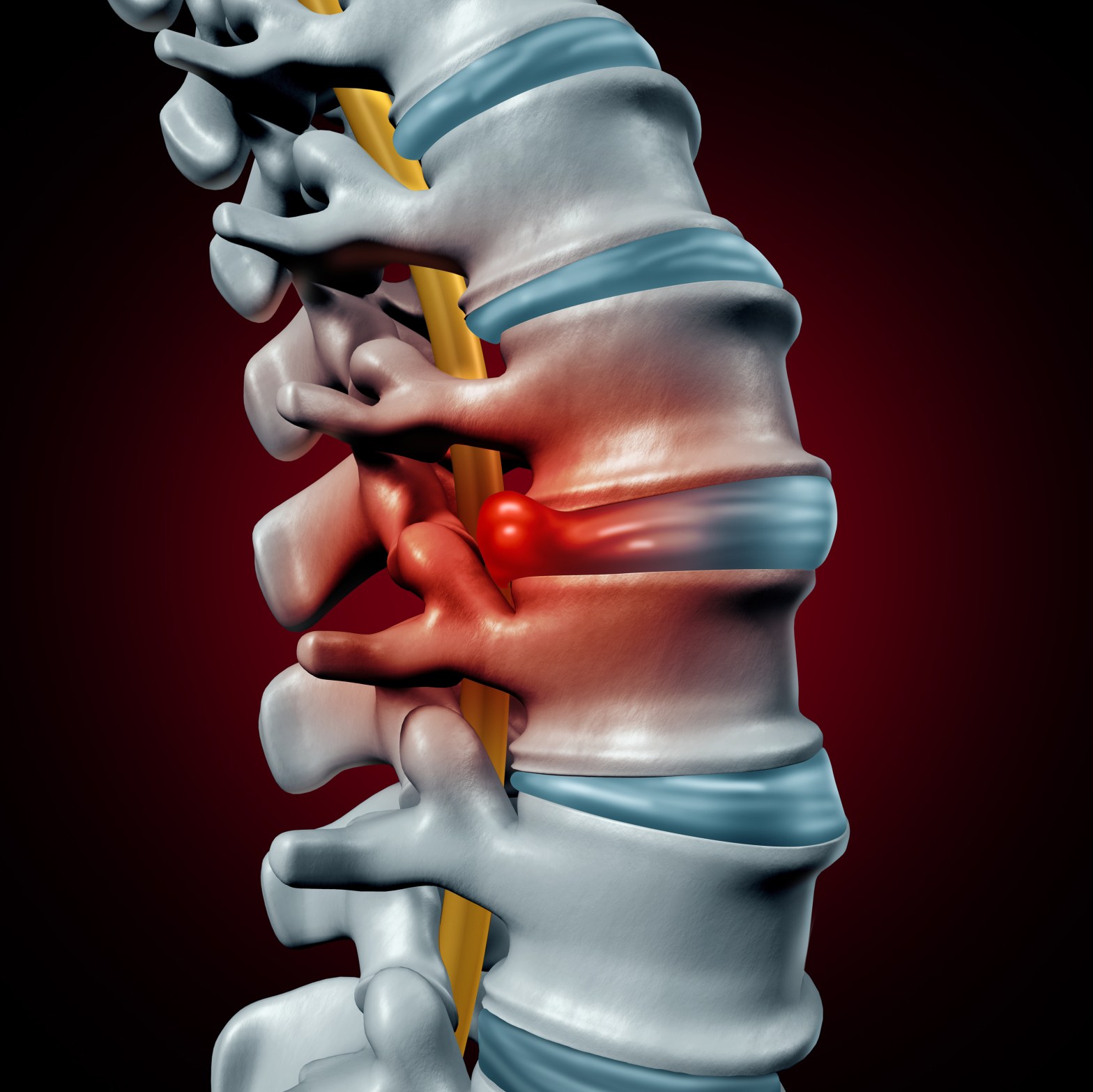 Anterior Cervical Discectomy And Fusion Surgery