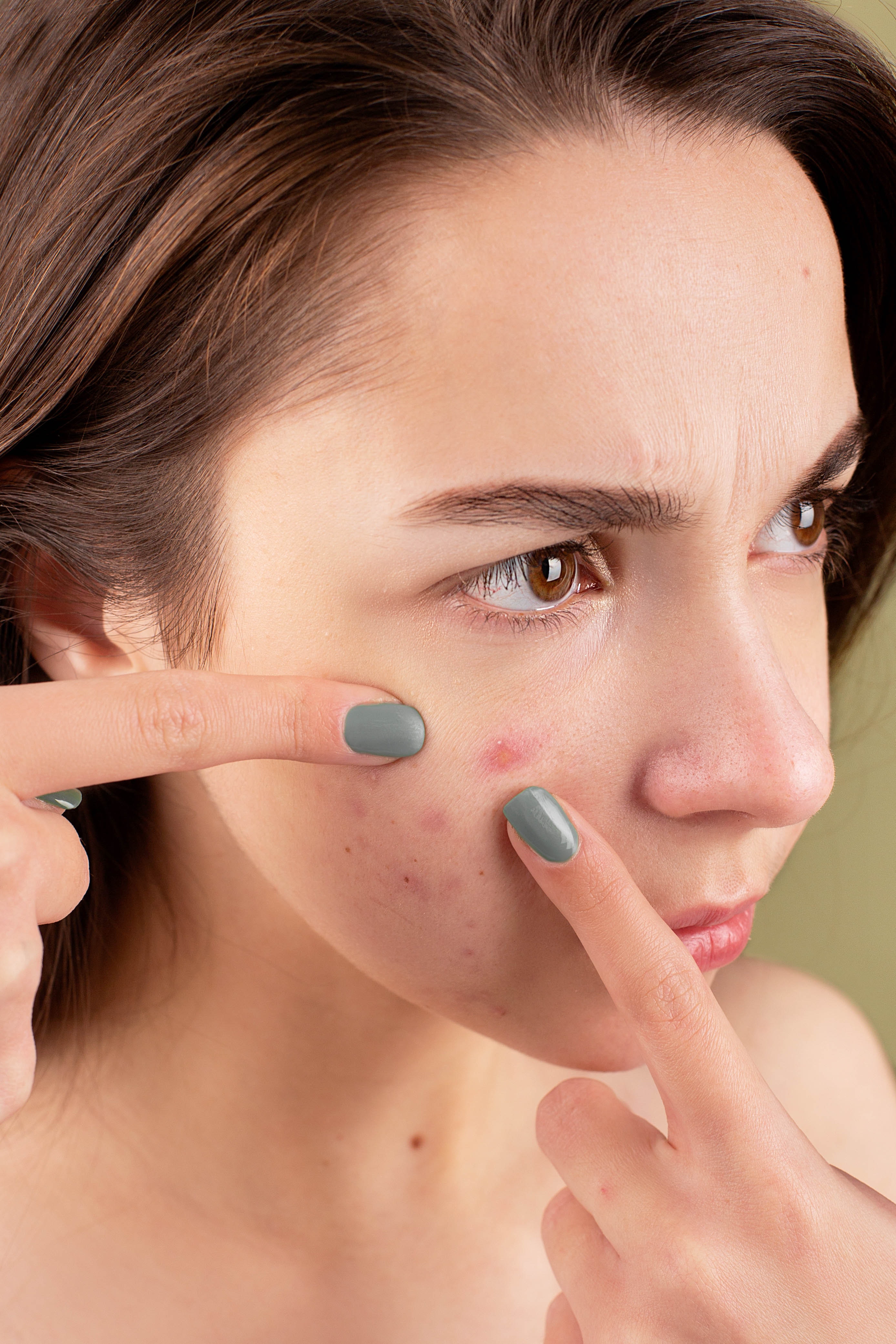 Get rid of acne in hot weather of Pakistan