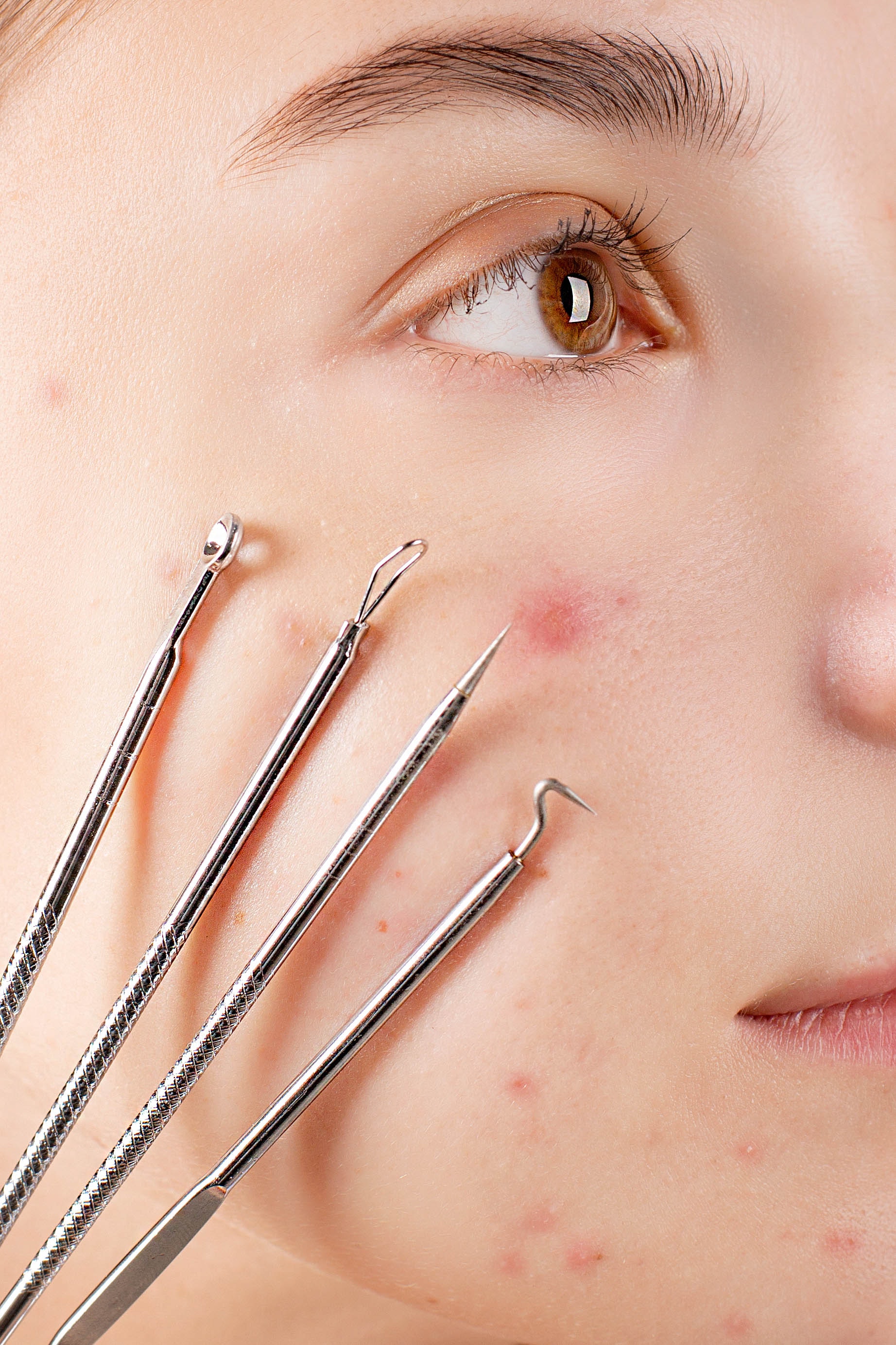 Acne treatment in Lahore
