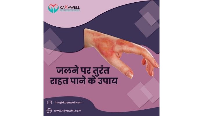 जलने पर राहत पाने के उपाय