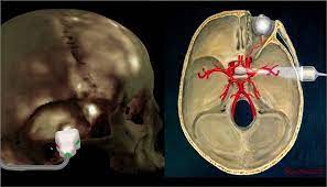 Global Transcranial Doppler Market Report, Latest Trends, Industry Opportunity & Forecast to 2027