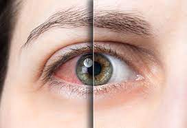 Global Dry Eye Syndrome Market 2021 - Top Key Players Analysis Report Till 2027