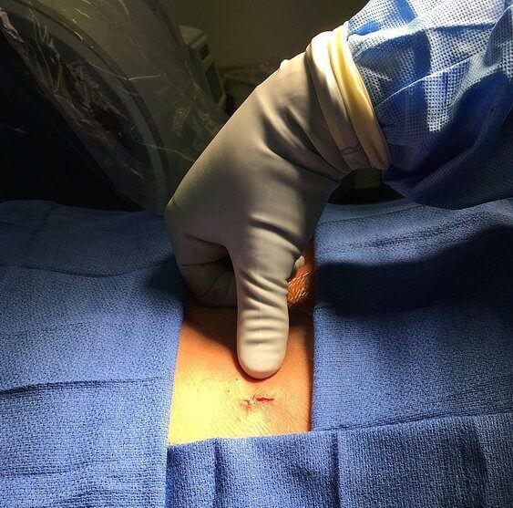 Endoscopic Discectomy