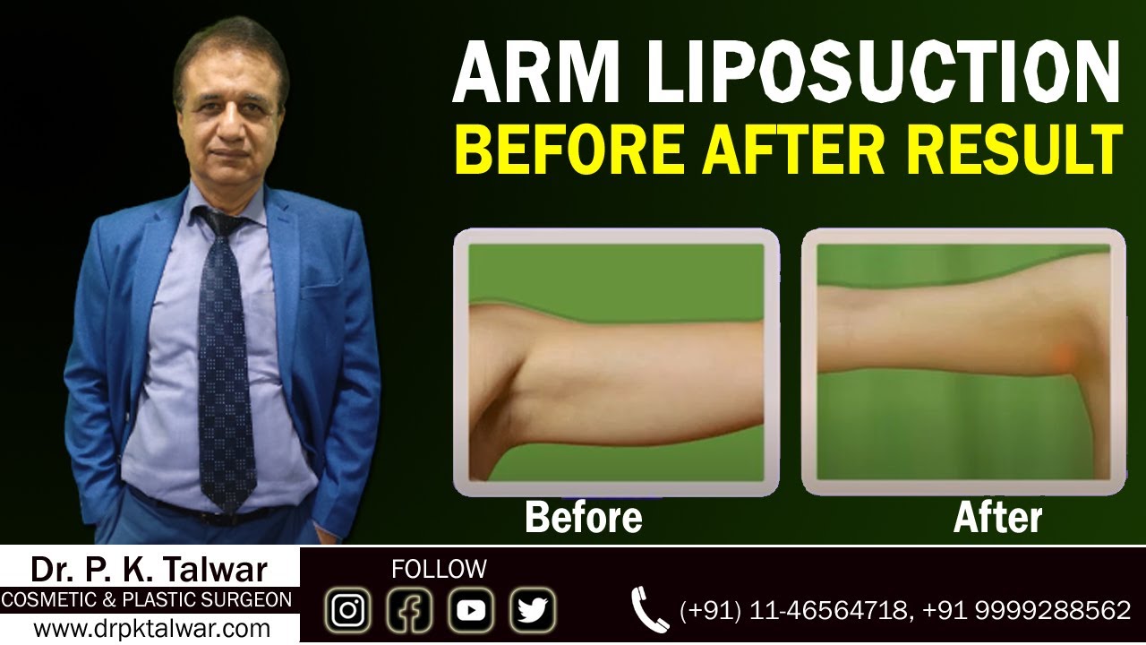 Advantages of Liposuction Surgery