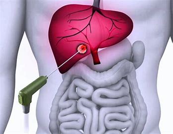 Oncology Ablation Market Drivers, Restraints and Challenges Analysis Report 2021-2027
