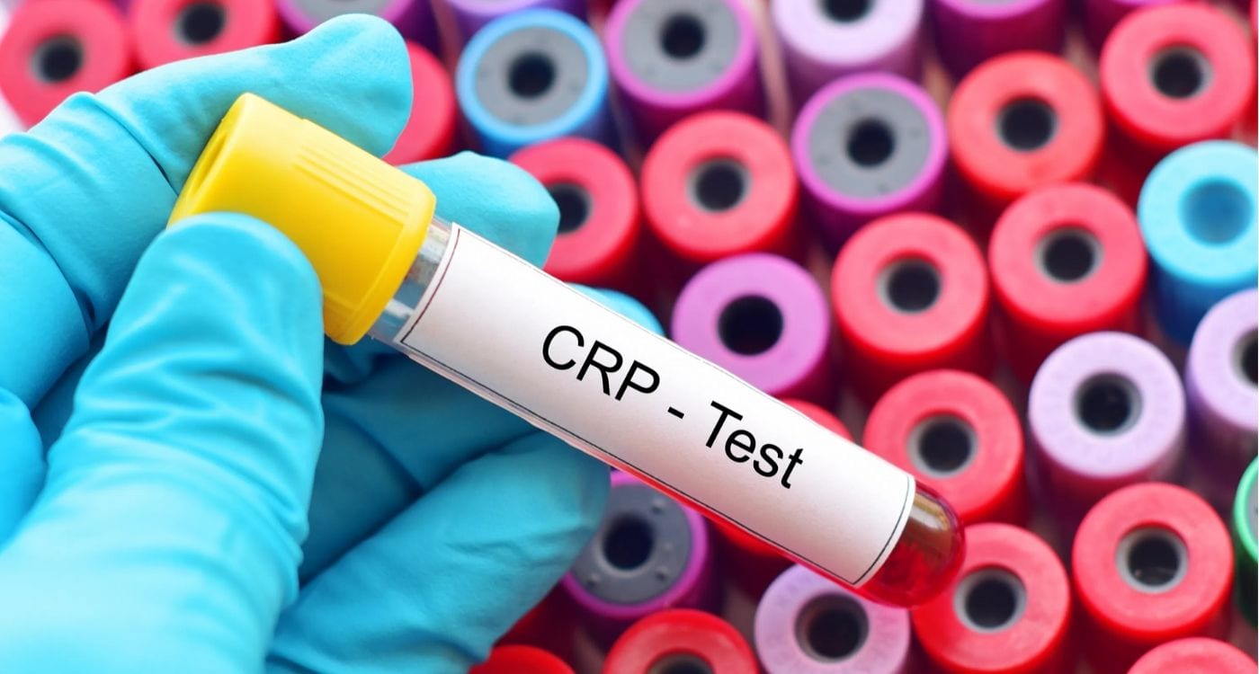 C-Reactive Protein Test Market | Global Industry Trends, Segmentation, Business Opportunities & Forecast To 2027