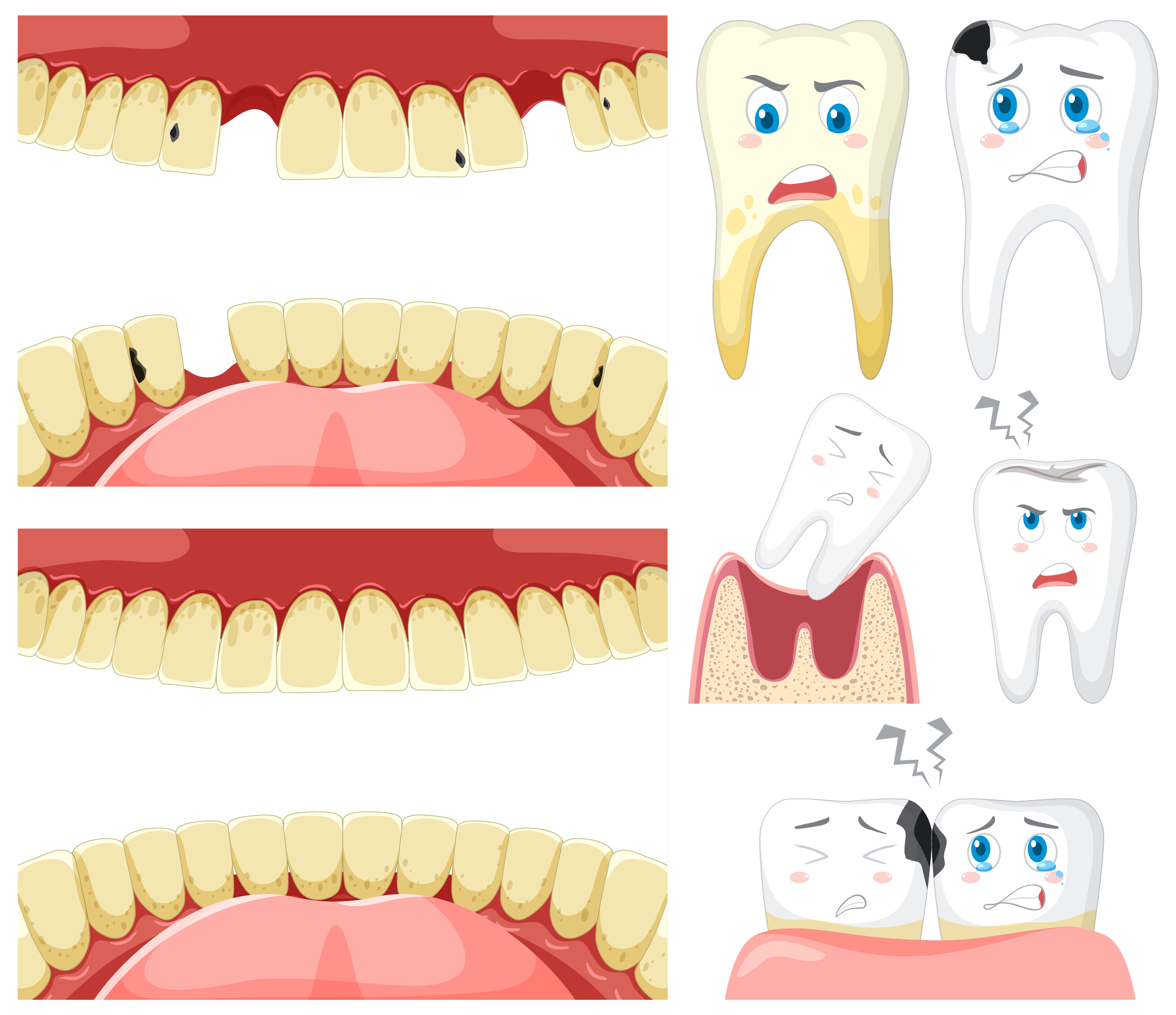 Chipped and Broken Teeth: Causes and Solutions