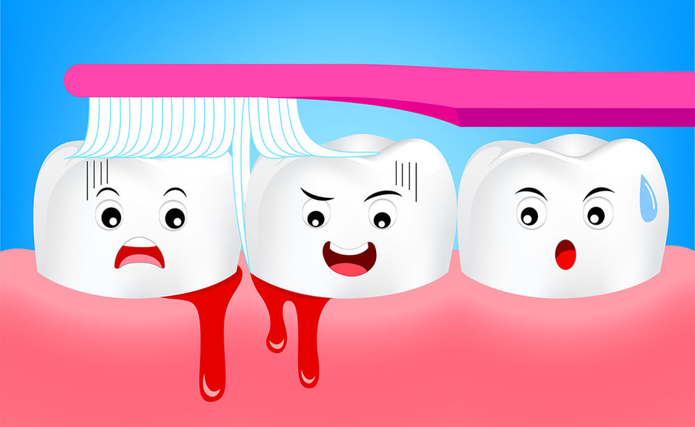 Teeth Bleeding - Natural Remedies For Bleeding Gums
