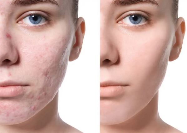 Unani Medicine - How To Remove Pimples From Face