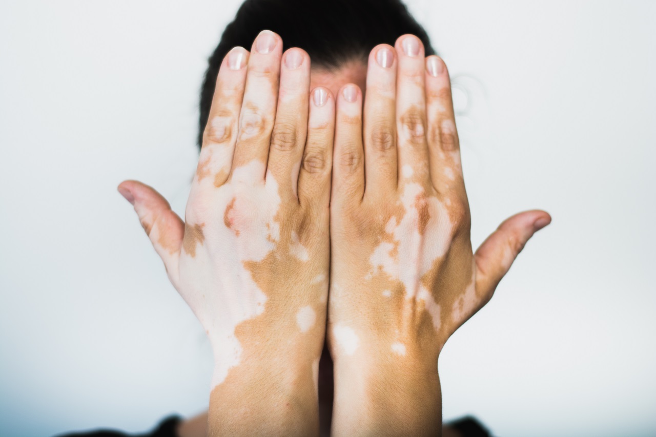 Remedies For Vitiligo - How To Cured My Vitiligo Naturally