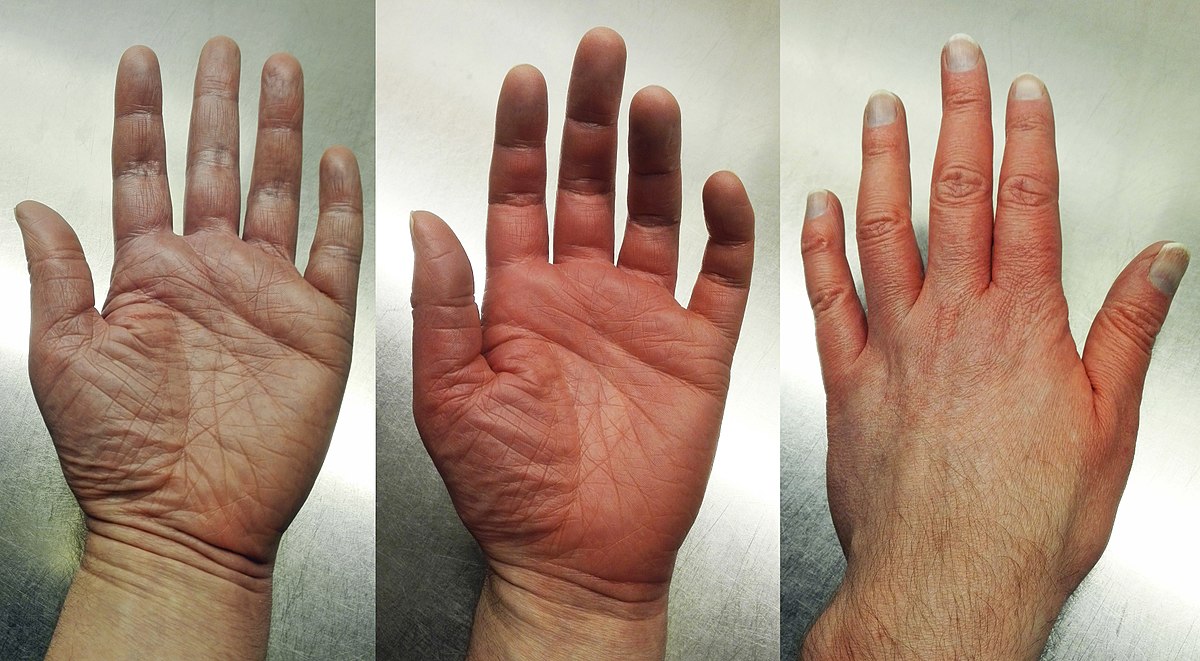 Erythromelalgia Treatment Market Size, Key Players Analysis And Forecast To 2027 | Value Market Research