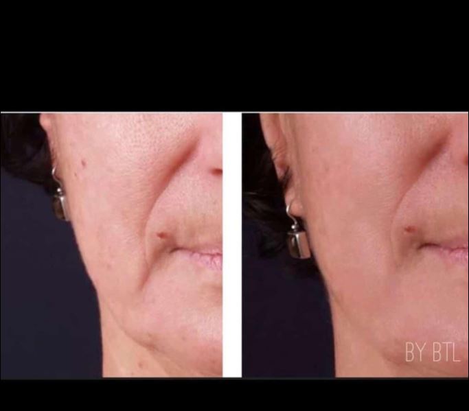 Facial Treatment in Perth | Dermedica Cosmetic Clinic