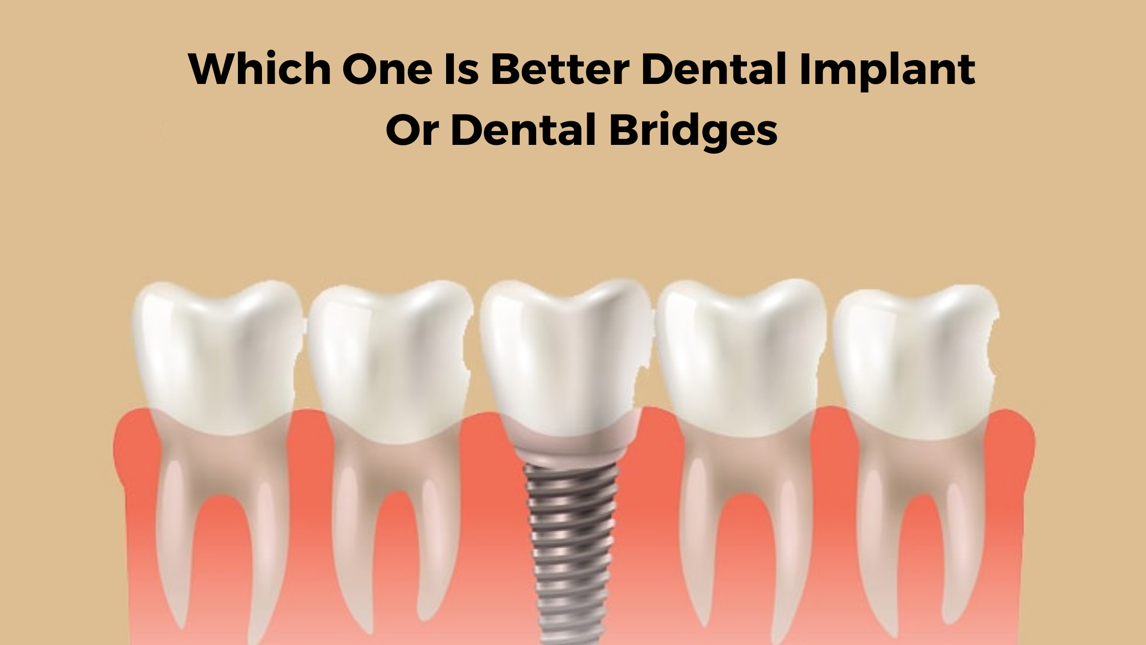 WHICH ONE IS BETTER DENTAL IMPLANTS OR DENTAL BRIDGES?
