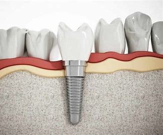 Bio-Implants Market Size, Drivers, Restraints Challenges, and Growth Opportunities Till 2027