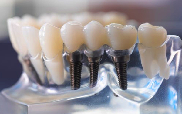 Affordable Dental Service in New Zealand