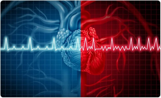 Global Atrial Fibrillation Market 2022: COVID-19 Impact Analysis and Industry Forecast Report, 2028