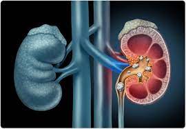 Cystinuria Treatment Market 2021 Major Key Players and Industry Analysis Till 2027