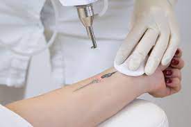 Global Tattoo Removal Lasers Market Report, Latest Trends, Industry Opportunity & Forecast to 2027