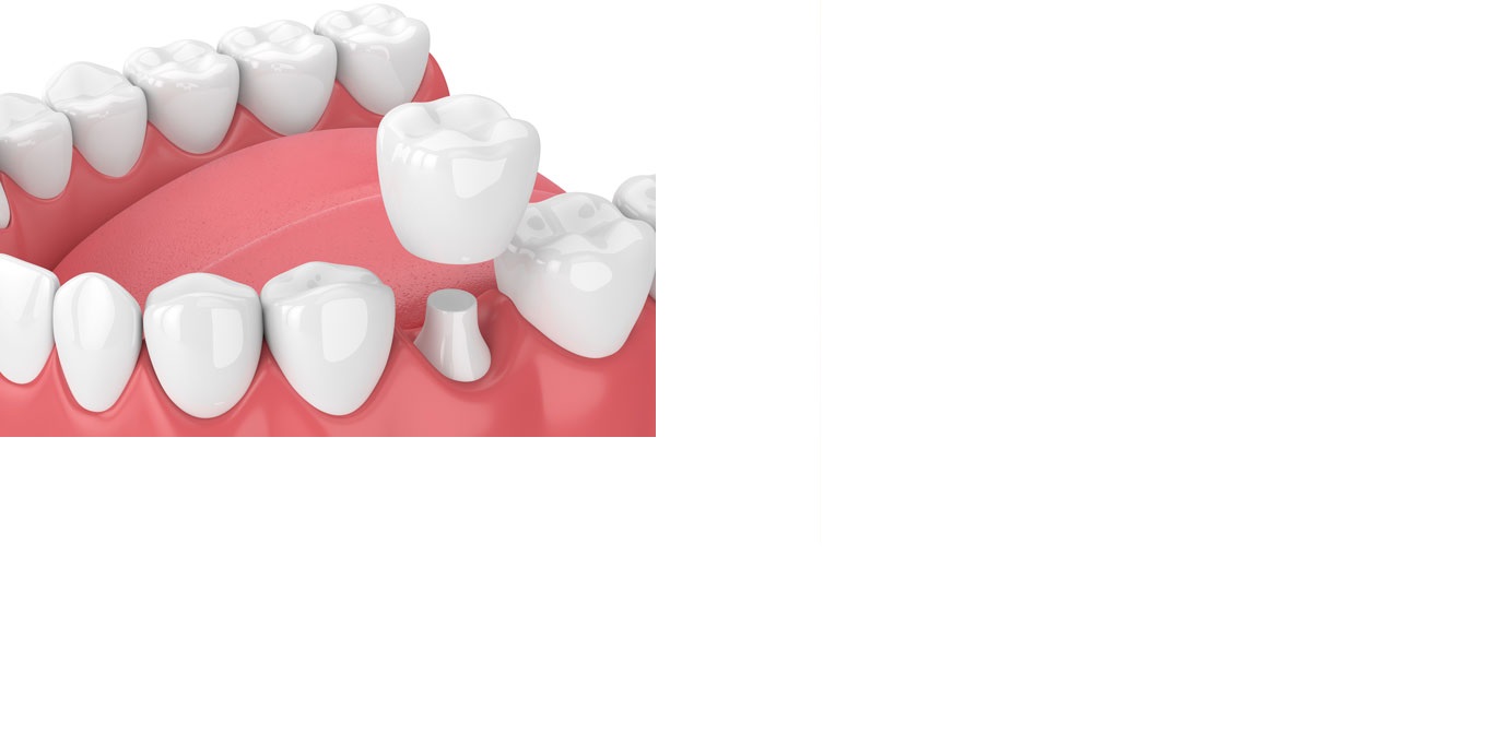 Dental Crown and Tooth Crown