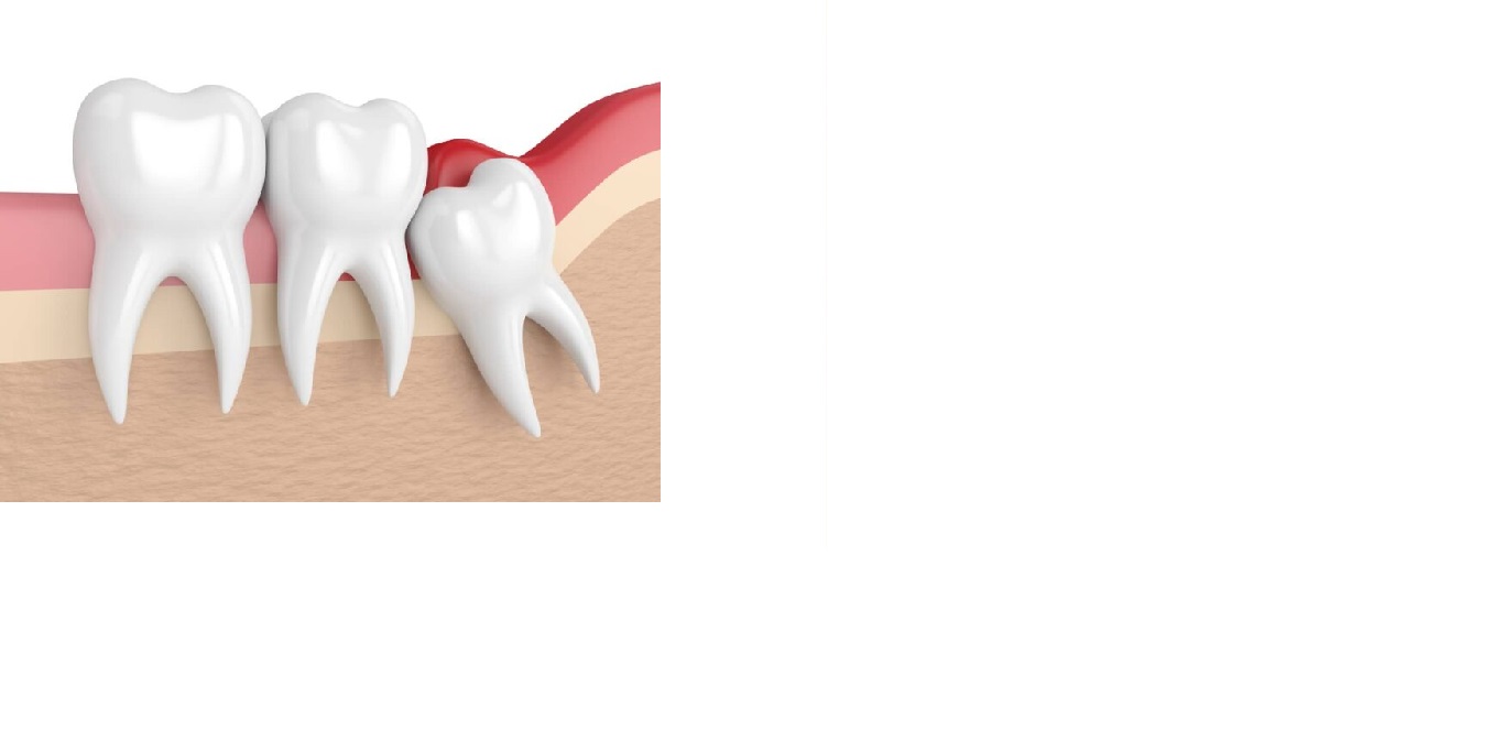 Wisdom Tooth Removal